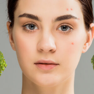 Dieta per l’acne: cibi da mangiare e da evitare Dieta per l’acne: cibi da mangiare e da evitare